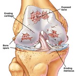 Артроз коленных суставов лечение форум thumbnail